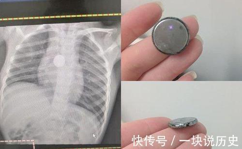 李女士|5岁女童莫名暴瘦,妈妈一句“我孩子没戴项链”,惊醒了医生