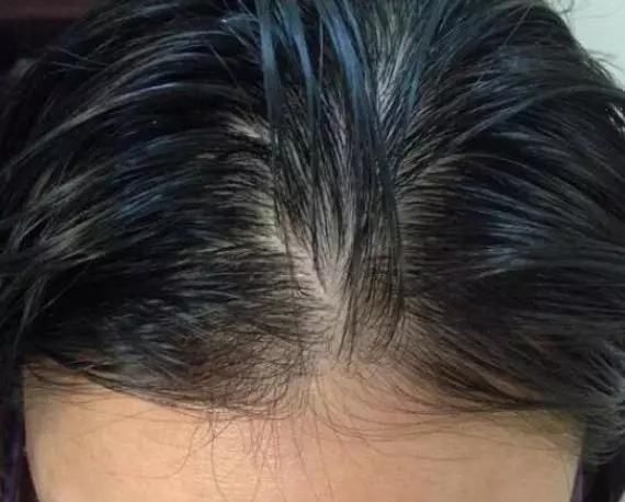 掉头发|头发上有这“4个现象”,可能是长螨虫了,教你一招,轻松除螨