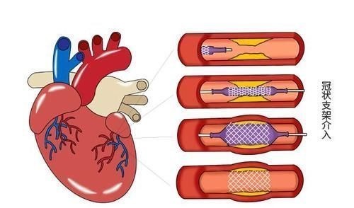 支架|心脏放了支架，还能活多久？能长寿吗？医生不隐瞒，坦诚说出答案