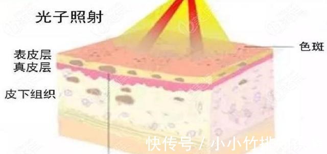 胶原蛋白 bb光和光子嫩肤的区别!