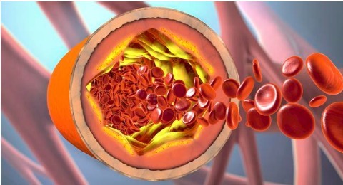 斑块|如何预防动脉粥样硬化,预防颈动脉斑块医生介绍3个有效办法