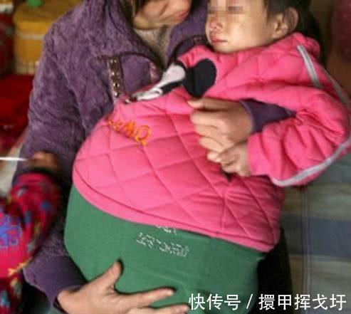 良性|7岁小女孩“怀孕”,医生取出“胎儿”后,父母怀疑自己的眼睛。