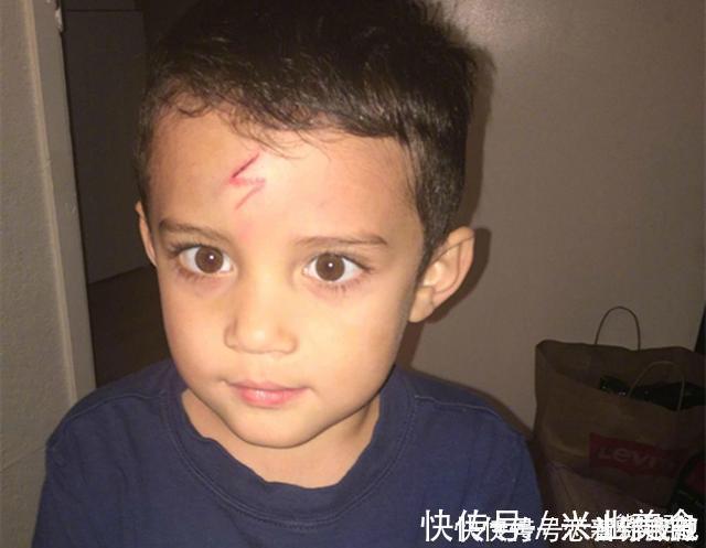 宝妈|男孩不小心磕破了额头,宝妈灵机一动,让娃变成了“哈利波特”