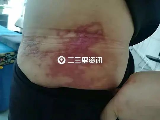 第一医院|女子抽脂手术后出现瘢痕维权难，瑞鑫医美：对方体质原因导致