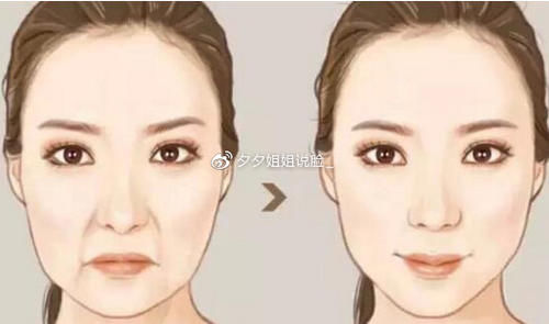 自体脂肪鼻唇沟填充的禁忌，自体脂肪鼻唇沟填充的优点有哪些？