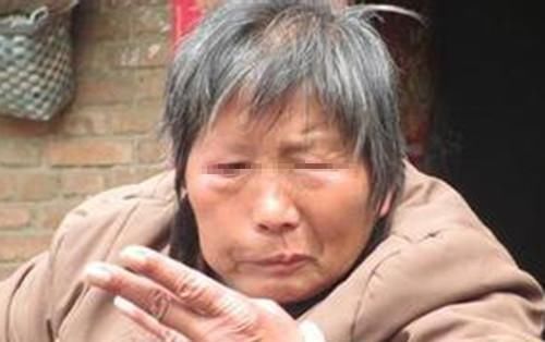 50岁后，“面部”出现3个异常，可能是脑出血要发生，希望你没有