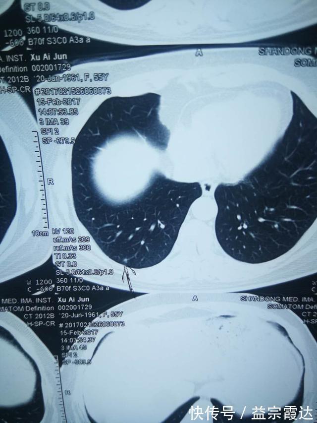 肺结节|CT照出肺结节，是不是得了肺癌医生终于说了大实话