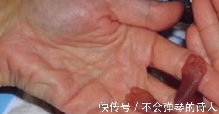 生命力|出生时仅25厘米的“拇指姑娘”,曾被断言活不过3月,却健康长大