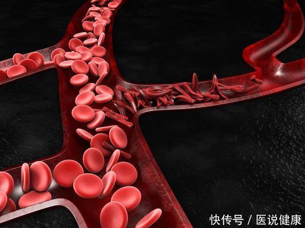 血管健康|血管怕堵,常吃这5种食物,有降血脂预防血栓的作用
