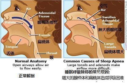 扁桃体肥大|家里有孩子的看过来,宝宝睡觉打呼噜,要引起警惕啦