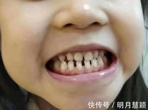 宝宝|宝宝长出吓人的双排牙,只因宝妈准备饮食时,多做了一件事