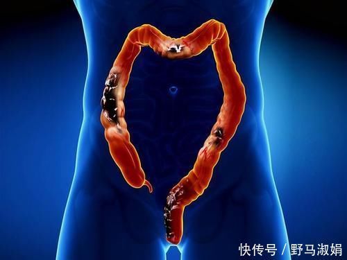 肠胃|便秘让人烦恼,但身边这3种饮食有润肠、通便的作用,不妨来看看