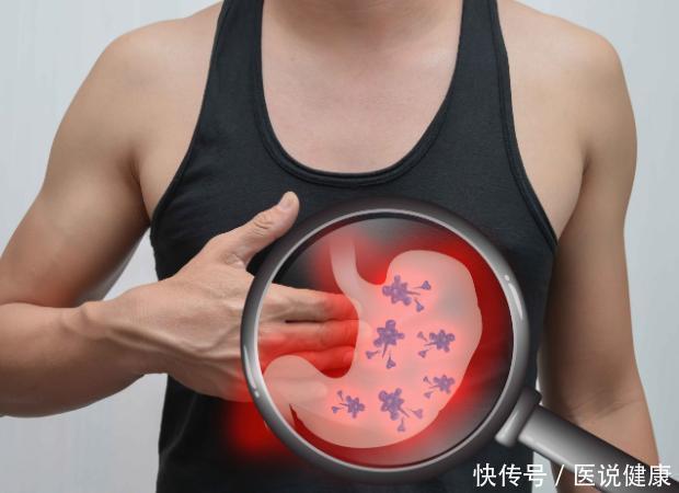 腺瘤性息肉|什么叫“癌前病变”这四类常见的癌前病变，现在了解还不算晚