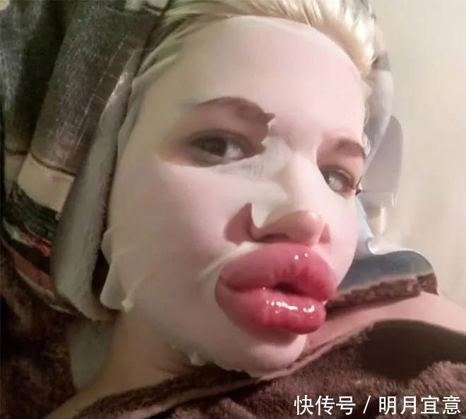 21次丰唇手术之后，这个妹子的嘴唇现在长这样…
