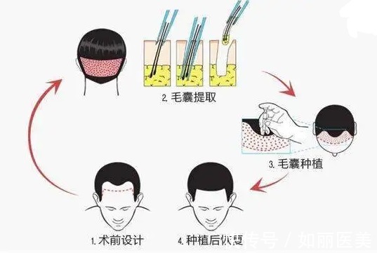 手术 斑秃植发多少费用,有影响么?科普干货为你分析,2022新参考价!