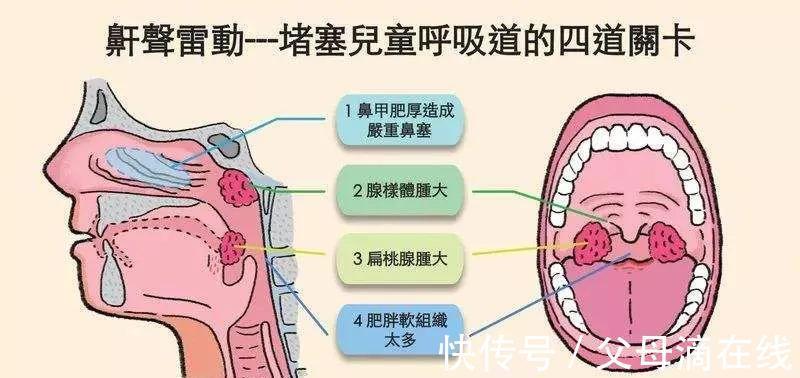 睡眠呼吸暂停|别让漂亮的孩子变成“丑小鸭”——腺样体肥大影响孩子的容貌