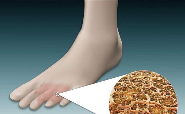 真菌|“脚气”真菌怎么做才能根除?2个简单小方法,彻底治好不复发!