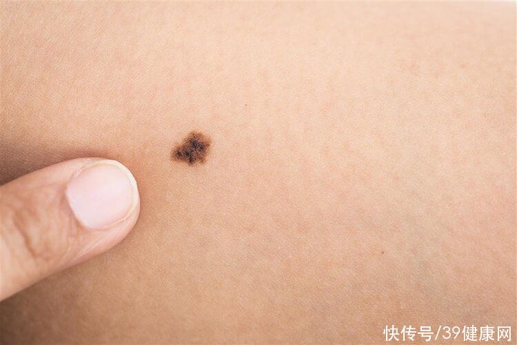 复发|得了灰指甲怎么治？这2个治疗方法效果好，安全不复发，赶紧学学