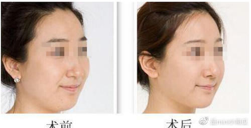 光纤溶脂瘦脸可靠吗？术后多久能看到效果？