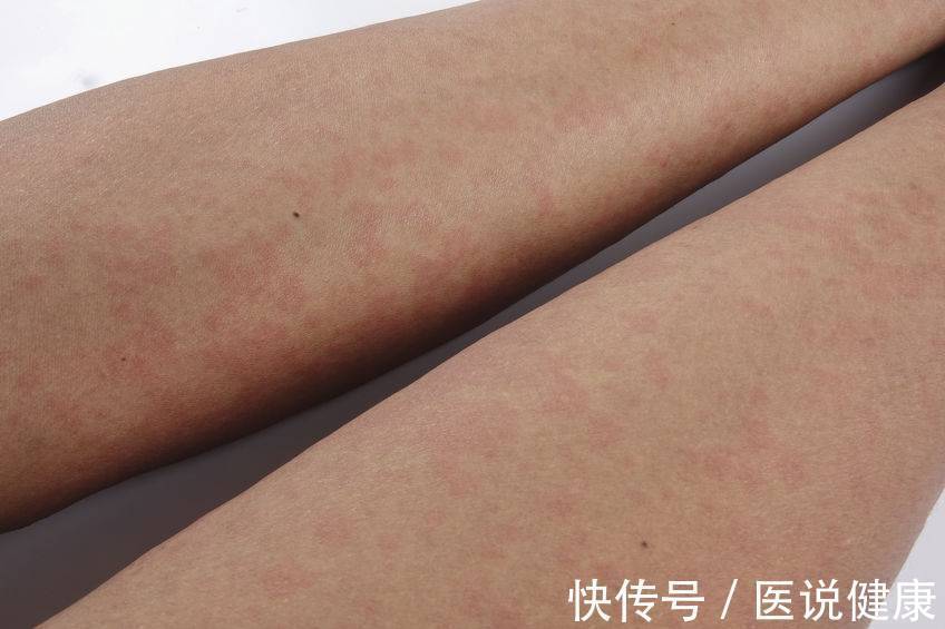 对症治疗|荨麻疹反复发作,或与这5个因素有关,找出病因,才能有效控制