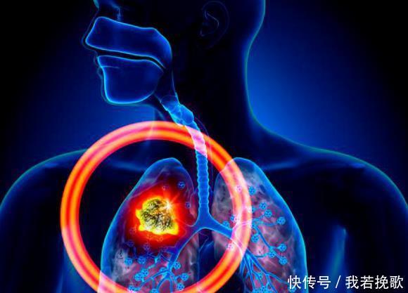 明知肺癌不可以治愈,为何还要花钱去治疗,现在疗效已经不一样