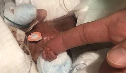 身体机能|母亲在怀孕期间长时间没有体重增加,婴儿只有268克,成为世界上最小的男孩