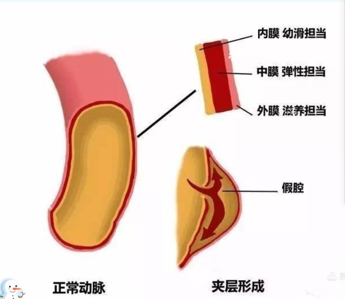 隔绝术|患者突发主动脉夹层，寿光市人民医院医生成功手术化险为夷