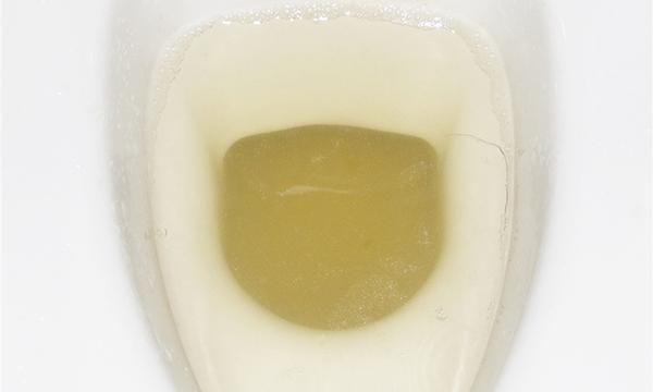 医生|上厕所时,若出现4个症状,或和肝癌有关,医生需留心观察