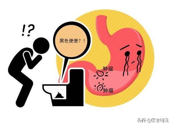 肿瘤|胃癌一查就是晚期？告诫：无端端出现4种变化，尽快去医院检查