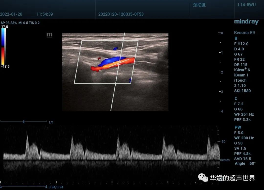 超声检查|典型病例?猎人弓综合征
