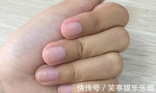 结节|夫妻俩先后查出肺癌，医生：手部早就给出提醒，却没及时发觉