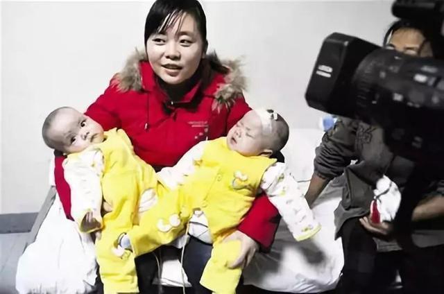 杨伟|我国首例“坐骨连体”双胞胎,成功分开11年了,她们现在还好吗