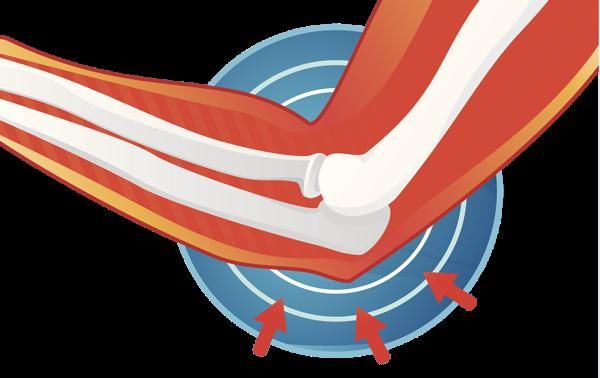 骨关节炎|这种疾病年轻人千万别轻视!