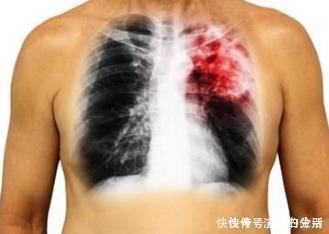 放弃|癌症治愈率可以达七成,但是你不知道此类东西,就等于放弃治疗