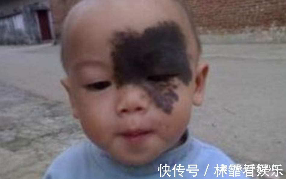 化学物质|越来越多胎儿被“胎记”缠身,若不想孩子自卑,孕妈要管住自己