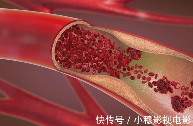 当心|血压高的人,多观察手指,若没有这3个异常,说明脑梗离你还很远