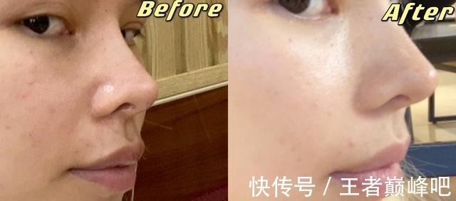 紧致 面部抗衰老,选热玛吉还是线雕提升!