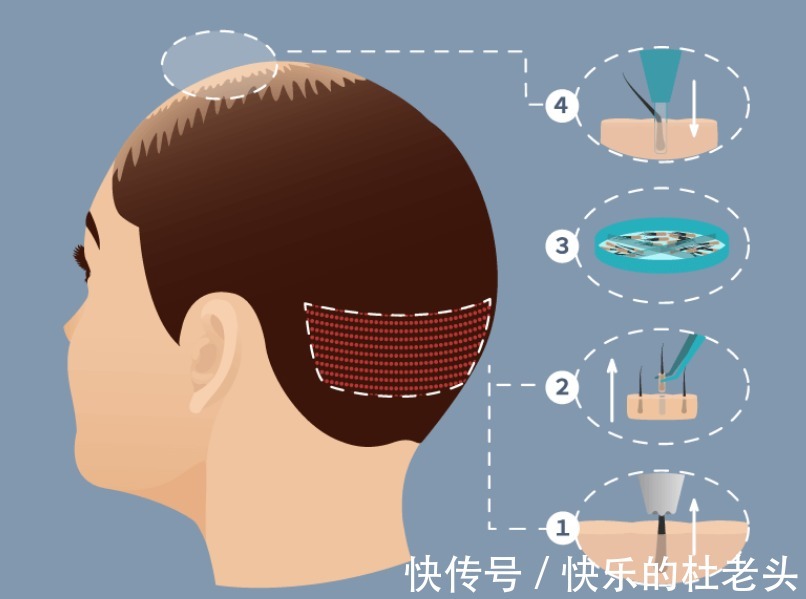 移植 植发后会掉发吗?谁要说百分百不掉发,不是心黑就是无知!