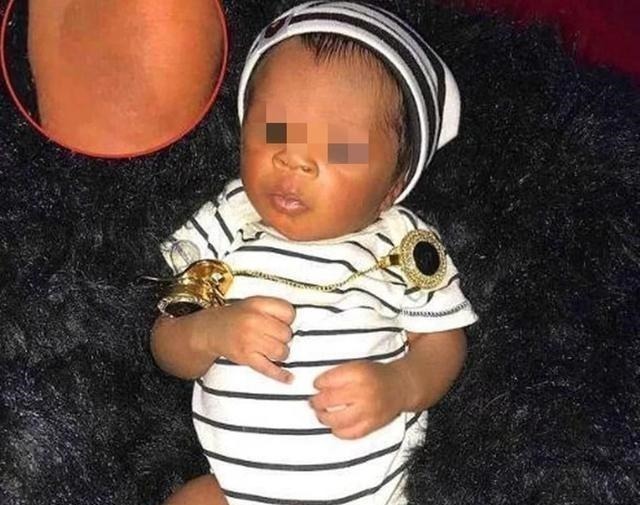 每日邮报|“最美胎记”,姐姐在胎中被弟弟吸收,变成胎记留在弟弟腿上