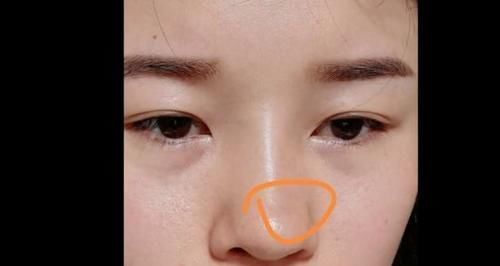 严女士|女子花了4万做整容,鼻子却留下一个坑?美容院:术前已告知风险