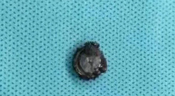 并发症|家长注意!三岁宝宝将纽扣电池塞入鼻孔三天