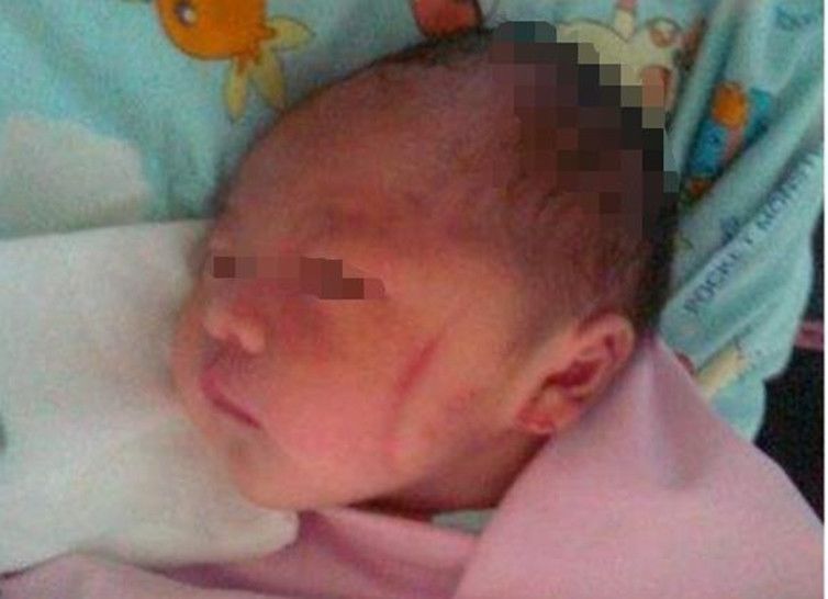 钳印|孩子1岁脸上“产钳印”不消,找医生被反驳,宝妈无言以对