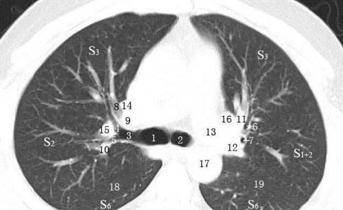 肺部CT怎么看？读2遍，会看气管和肺血管就入门了