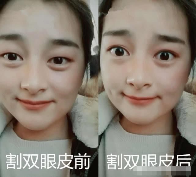 双眼皮|割双眼皮前VS割双眼皮后,看见差距,眼睛变好看了但灵魂没了