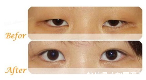 并发症 上睑下垂术后多久恢复自然?其实这1点才更该重视