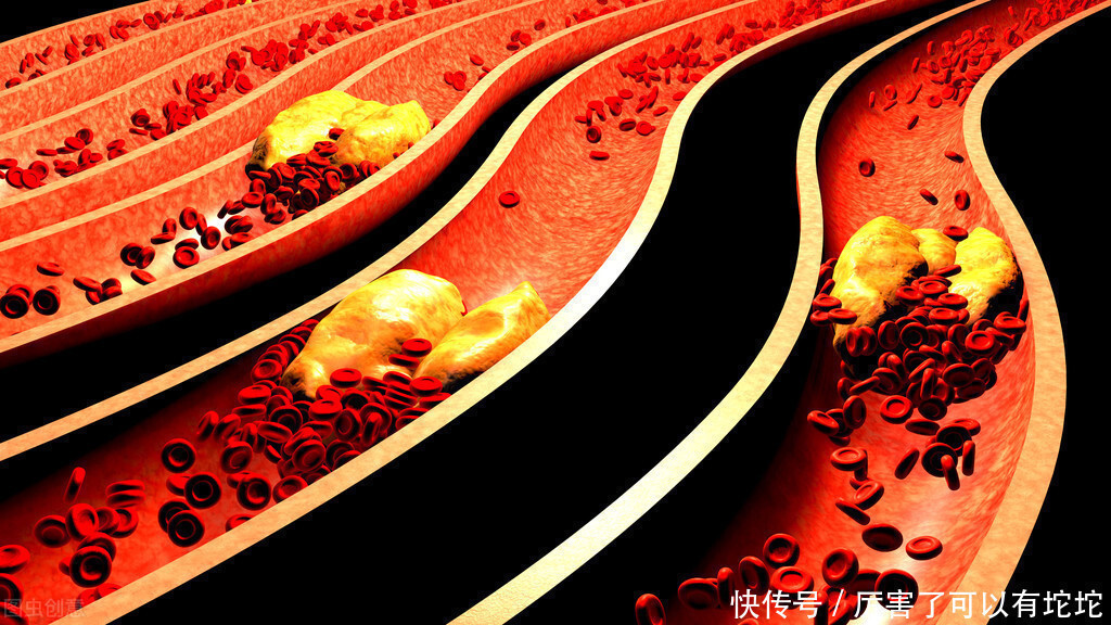 清道夫|血栓的清道夫找到了!大蒜排最后,排在第一的,很多人不知道