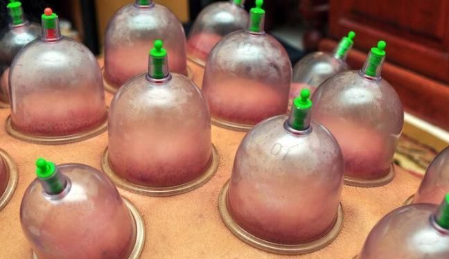 免疫细胞|年轻小伙拔罐治颈椎病,反把右肺吸没?中医:3类人不该拔罐