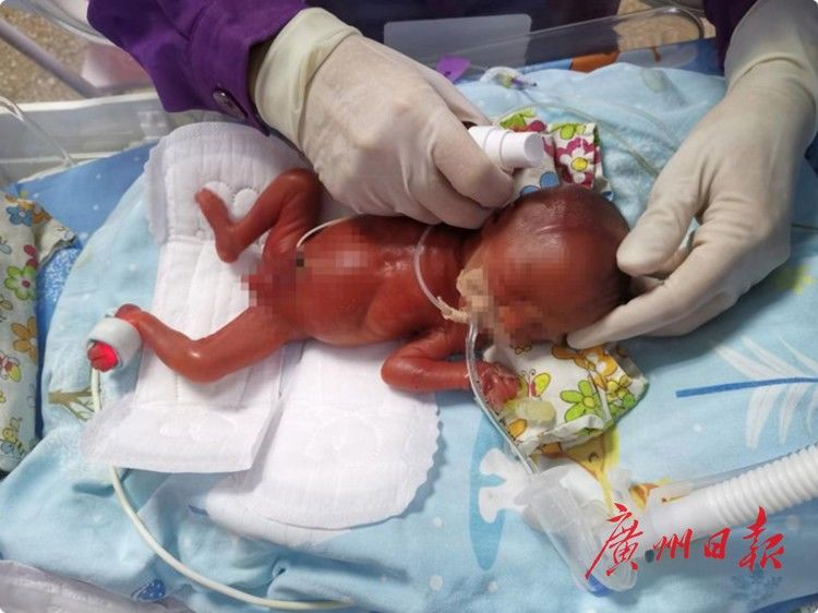 凯凯|超早产“巴掌宝宝”，140天生命闯关！看哭了……