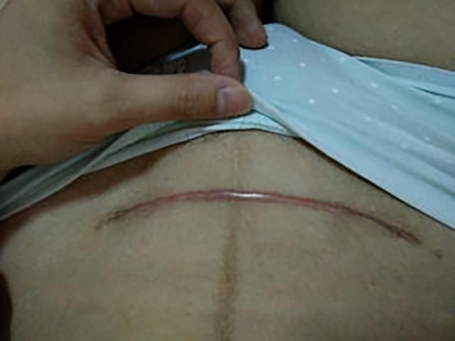 产检|宝宝只有6斤,却因产检时医生的误判,导致本想顺产只好选择剖腹