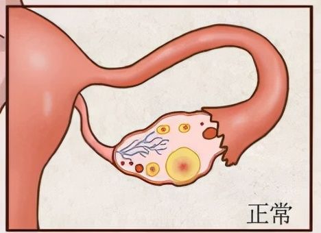 卵巢早衰|甲亢对女性健康有什么影响？35岁女士患甲亢月经不来了，甲状腺与女性生殖的关系医生总结三条